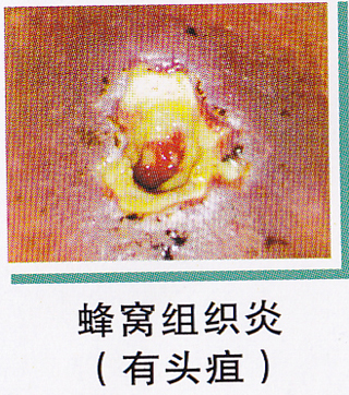 特色治疗化脓性疾病-疮 疔疖痈疽
