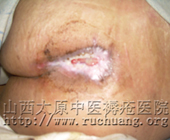 ��ĳ���У�56�꣬��β������9.5cm��10.2cm�촯���Ͳ���