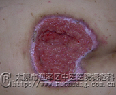 ��ĳ��Ů��53�꣬��β������11.2cm��8.7cm�촯���Ͳ���