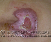 ��ĳ��Ů��53�꣬��β������11.2cm��8.7cm�촯���Ͳ���