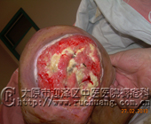 ��ĳ���У�69�꣬ϥ�ؽ����10.1cm��12.6cm�촯���Ͳ���