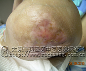 ��ĳ���У�69�꣬ϥ�ؽ����10.1cm��12.6cm�촯���Ͳ���